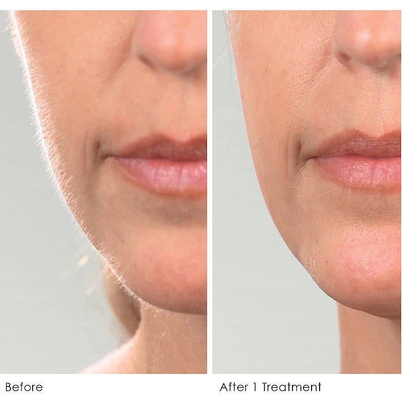 المفاهيم الخاطئة الشائعة حول Dermaplaning